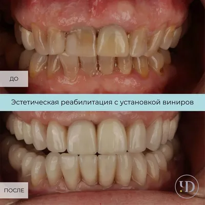 Фарфоровые или композитные виниры: что лучше? - Стоматология Москвы  \"Королевская Улыбка\"