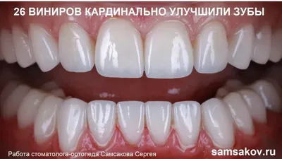 Керамические виниры (фарфоровые) - стоимость услуги Виниры в Киеве,  Керамические виниры (фарфоровые) - цена в стоматологии lipinskii.com.ua