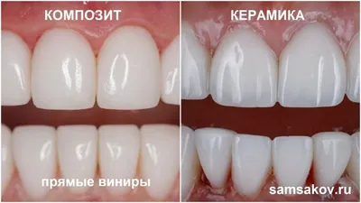 Керамические виниры в Минске: этапы и преимущества установки