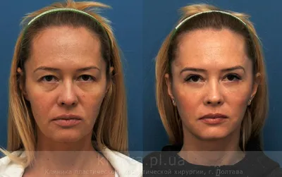 ᐉ Фото до и после — фейслифтинг, фотографии до и после операции фейслифтинг,  фото результатов операции