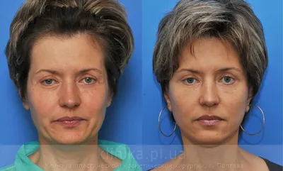 Фото до и после операции фейслифтинг