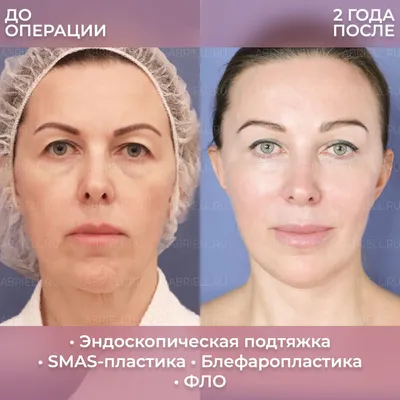 Круговая подтяжка лица → Фото результатов до и после пластической операции