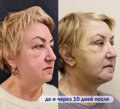 Пластика лица и шеи Калининград цены - фото до и после