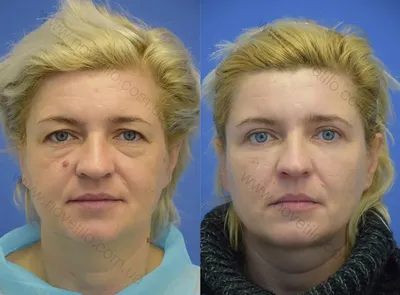 Фото до и после пластики лица, результаты работ | Баланс Здоровья
