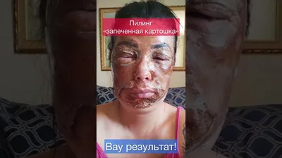 Феноловый пилинг- это самый активный и глубокий из пилингов. Имеет сво... |  TikTok