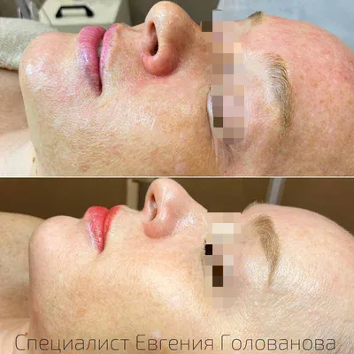 ProBeauty.md - Феноловый пилинг Fenol TCA easy от... | Facebook