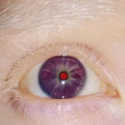 Фиолетовые глаза, натуральный цвет | Цвет глаз, Глаза, Альбинизм