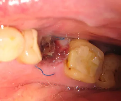 Белый налет на десне после удаления зуба - Underson Clinic