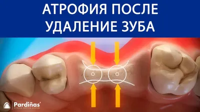 Афтозный стоматит: симптомы, диагностика хронического язвенного стоматита и  лечение слизистой оболочки у стоматолога