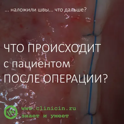 СТОМАТОЛОГИЯ в ЖК САМОЛЕТ on Instagram: \"Удалили зуб мудрости 🤒 ⠀ Многие  из вас уже столкнулись с такими проблемами, как болевые ощущения, повышение  температуры, отёчность и ещё некоторые неприятности ⠀ Частые вопросы