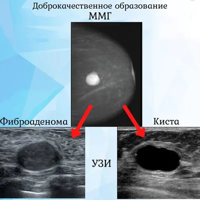 Расшифровка маммографии, Bi-RADS, пересмотр маммографии, описать маммографию