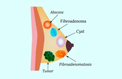 Onco_tlt - ⚪️Фиброаденома молочной железы – это... | Facebook