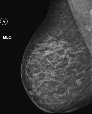 Цифровая маммография - Клиника медицинского университета