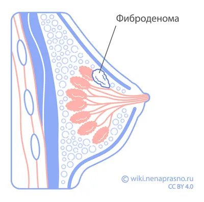 Фиброаденома молочной железы. | Реальный медик | Дзен