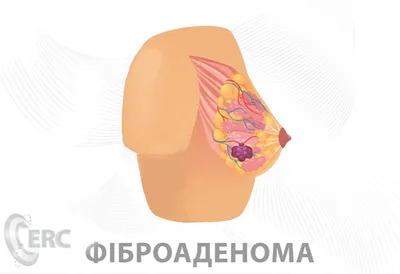 Диагностика фиброаденомы молочной железы в Иркутске в Клинике Эксперт