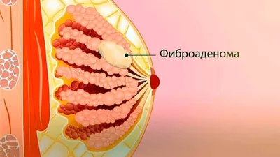 Фиброаденома молочной железы