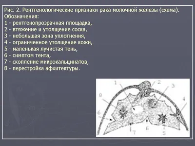 Фиброаденома молочной железы – симптомы, причины, диагностика и лечение  заболевания, прогноз и профилактика