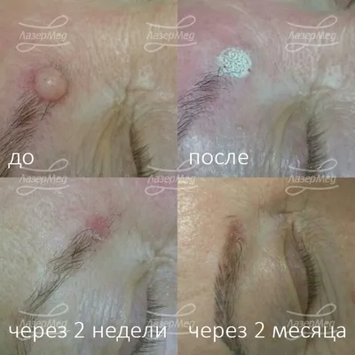 Удаление фибромы, фиброма кожи, лечение фибромы кожи