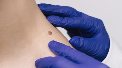 В течение 3.5 лет женщина отмечала рост пигментного образования на коже  плеча, в октябре этого года обратилась в частную клинику. Там… | Instagram