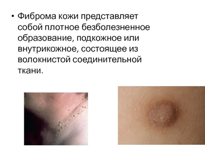 Мягкие фибромы - акрохордоны, папилломы - Приватный дерматологический  кабинет в Воронеже