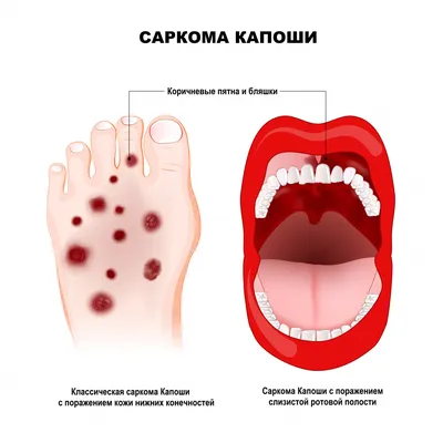 Типы сарком мягких тканей