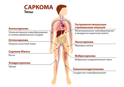 Что такое саркома?