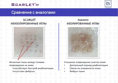 Фиброз в носогубных складках от филлера