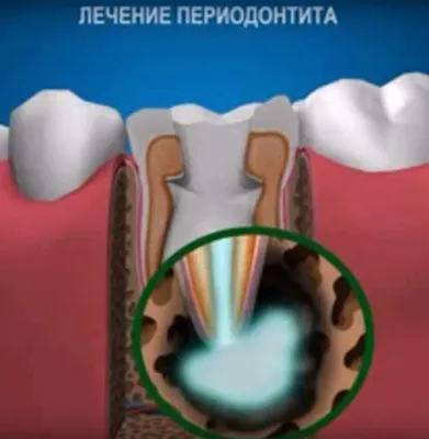 Опухоль на десне (эпулис): разновидности, причины развития, лечение