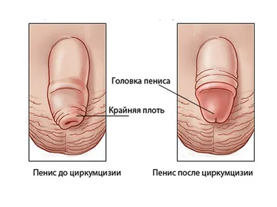 Лечение фимоза без операции у взрослых и детей в Москве - цены в клинике  АльтраВита