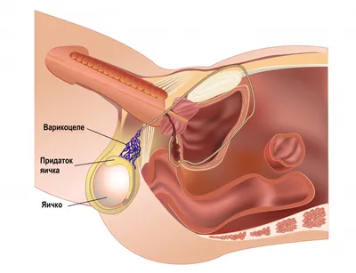 Фимоз у мужчин
