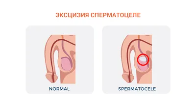 Как лечить фимоз без последствий | клиника лазерных технологий medcity.ua