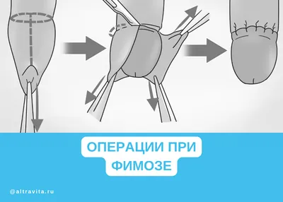 Обрезание крайней плоти в Москве – сделать операцию циркумцизио взрослому