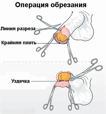 Фимоз у мужчин лечится обрезанием крайней плоти | 18+