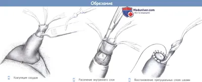 Обрезание крайней плоти в Киеве (циркумцизио) | Цена операции