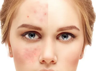 Что такое купероз кожи лица? Удаление сосудистой сеточки на лице лазером |  клиника Лазерсвiт