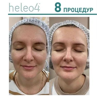 Фотодинамическая терапия HELEO4 в Москве: цена процедуры клеточного  омоложения кожи в клинике