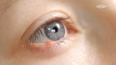 Infection in Eye. Red-eye syndrome: how to treat it! | Орган Зрения