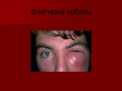 Диссертация на тему \"Гнойно-воспалительные заболевания орбиты -  субпериостальный абсцесс и флегмона (клиника, диагностика, лечение)\",  скачать бесплатно автореферат по специальности 14.00.08 - Глазные болезни