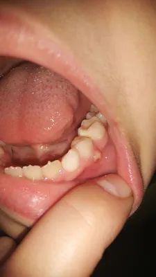 Как лечить флюс зуба - блог Dantistclinic
