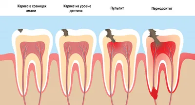 Опухла щека после лечения зуба - Что делать и куда обращаться?