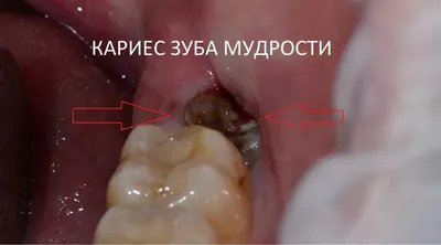 Флюс у ребенка: причины и симптомы, методы диагностики, лечения и  профилактики - SHiFA