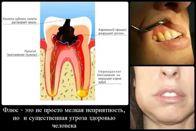 Что такое флюс и почему требуется лечение в стоматологии – ЧЕline |