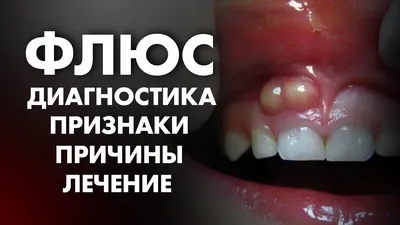 Флюс У Ребенка 9 Причин Лечение Как Убрать ЛюмиДент