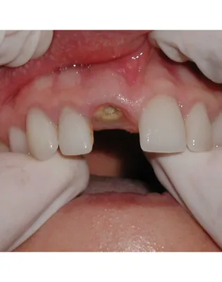 Лечение флюса зуба у детей: причины появления флюса на сайте «Мартинка»