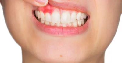 Всё про флюс: причины, симптомы, лечение - блог стоматологии Vip Line