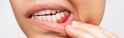 Флюс зуба - диагностика и методы лечения | Стоматология Atlantis Dental