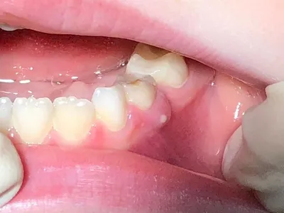 Флюс после удаления зуба: что делать для профилактики | Dental Art