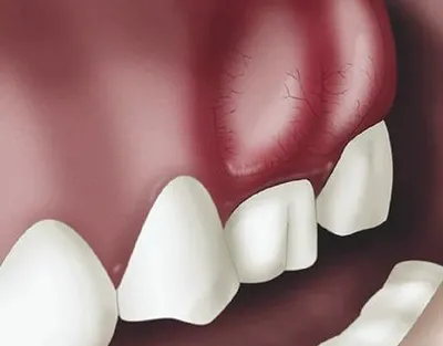 Флюс на десне: Что такое флюс зуба 🦷 Как его как лечить? | CIS