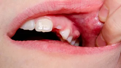 Удаление зубов - «Киста, пломба, ФЛЮС на щеке, лечение в домашних условиях  и удаление 6 зуба, грудное вскармливание и антибиотики. Все прелести  операции, как это было...» | отзывы
