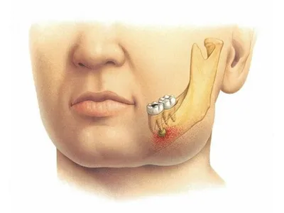 Флюс зуба: лечение и симптомы — Стоматология МедМар